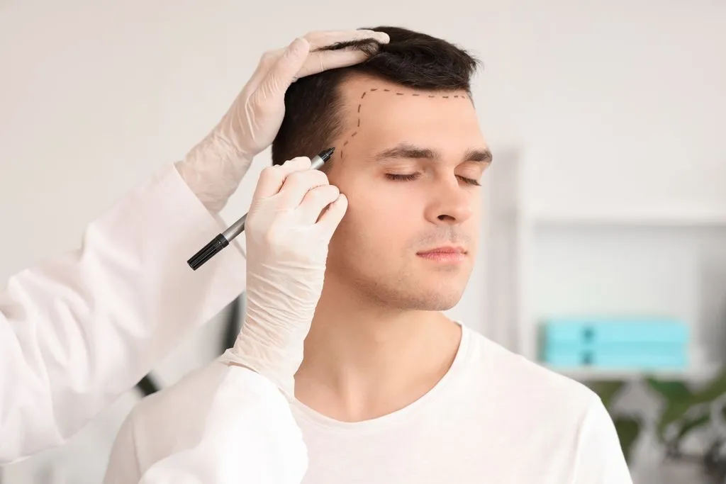 Hair Transplant Treatment in Turkey